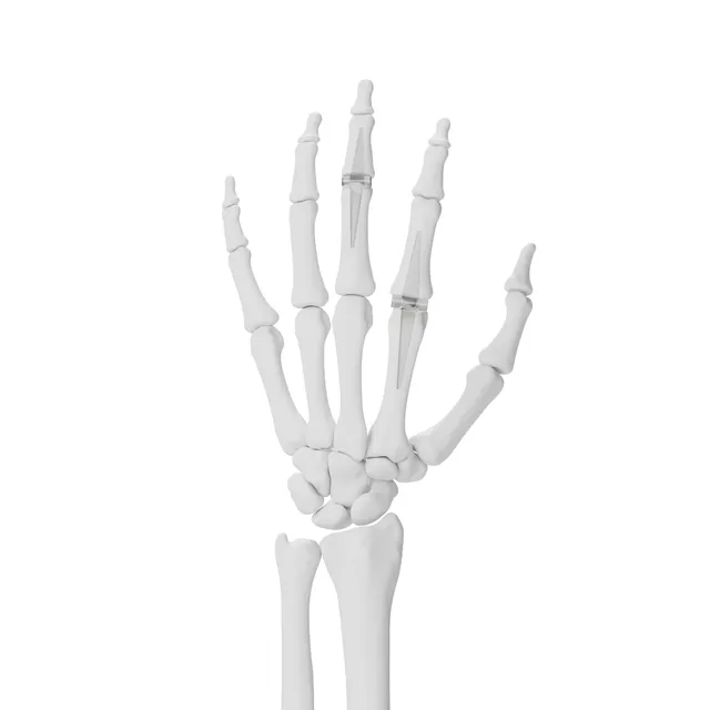 Silicone Finger Implant · foto 2