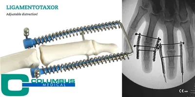Ligamentotaxor op het NVvH-congres