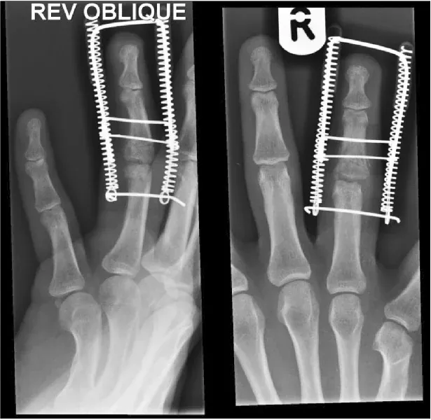 Ligamentotaxor · FingerFix aanvullend beeld