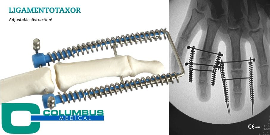 Ligamentotaxor op het NVvH-congres